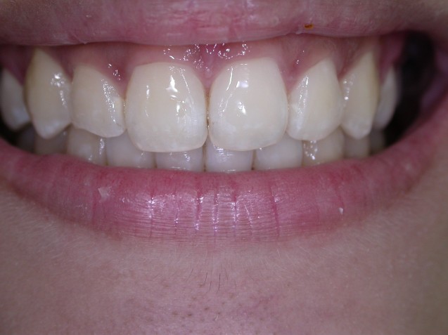 Ortho Smile #4
