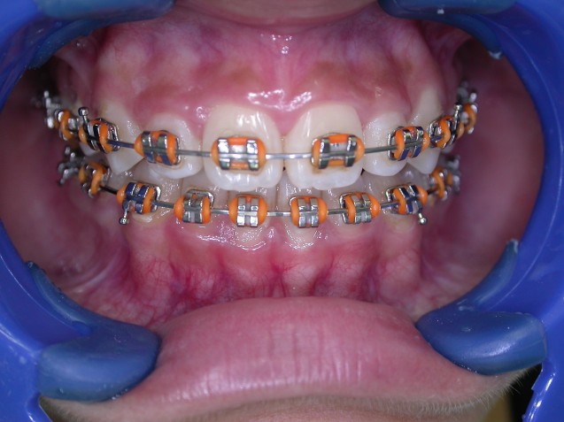 Fixed Ortho braces