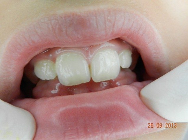 Deep bite, mixed dentition