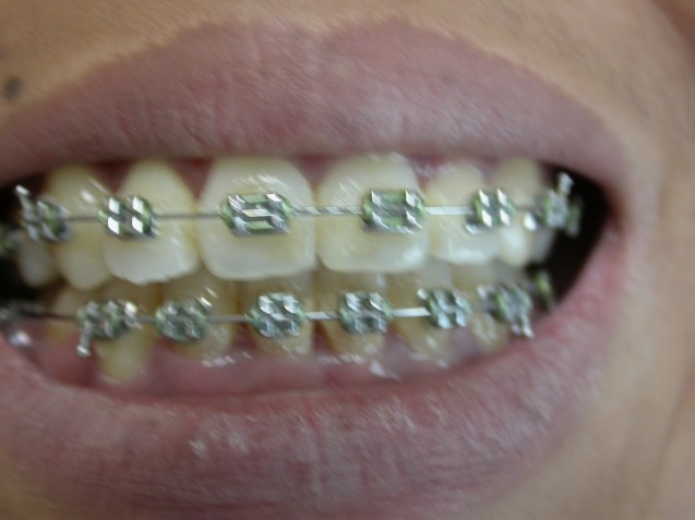Fixed orthodontic appliance