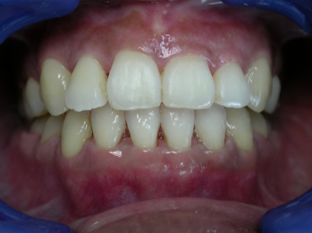 ortho smile, after debonding