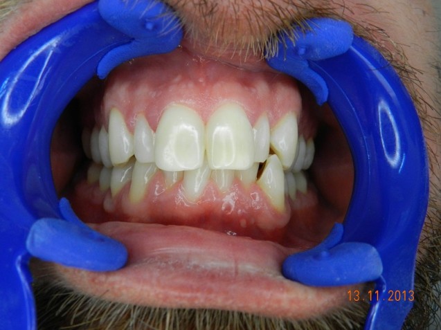 Cerinate veneers,before