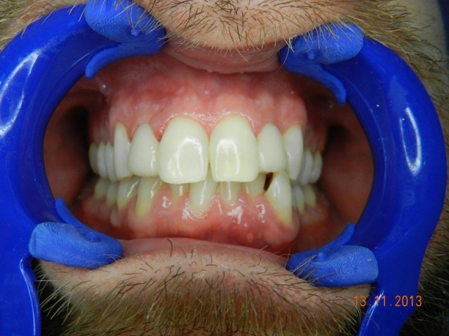 Cerinate veneers ,after