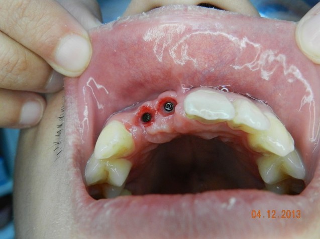 Implant incisors #4.0