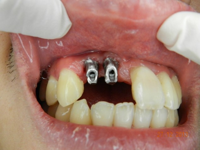 IMplant incisors #4.1