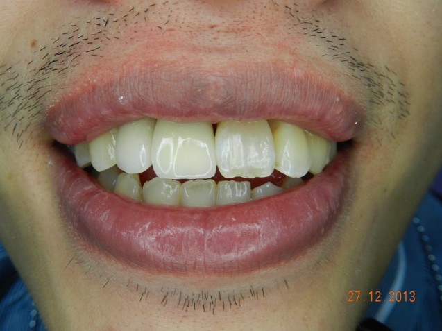 Implant incisors #4.2