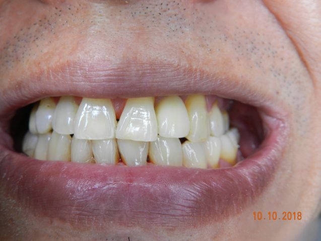 Implant lateral incisor
