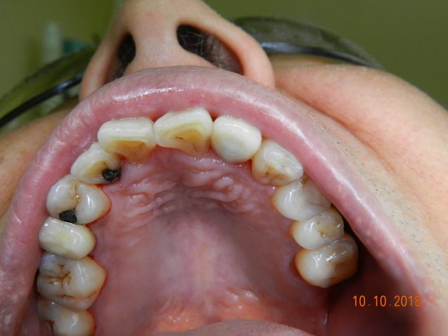 Implant lateral incisor