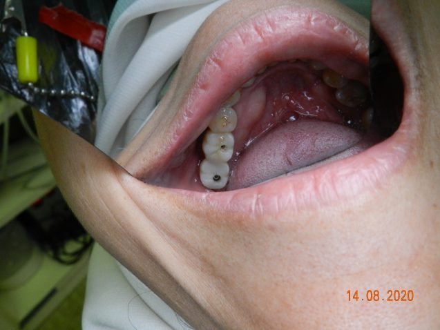 Lower molar implants