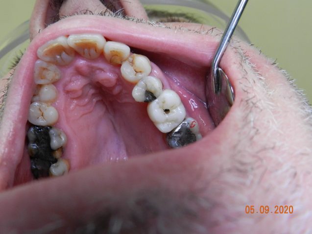 Implant upper molar
